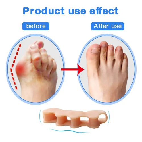 Before and after effect of a foot product showing reduced redness and inflammation.